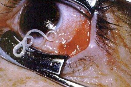Worms in a person's eye